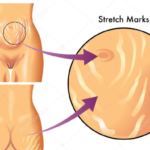 Symptoms and origin of Stretchmark
