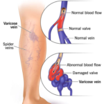 Why do veins swell?