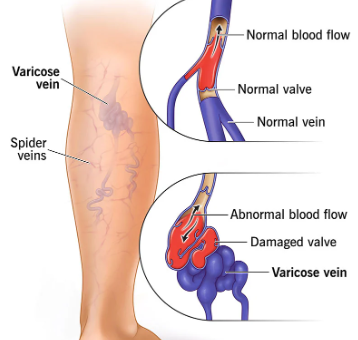 Why do veins swell?